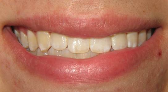 case-13-after-invisalign