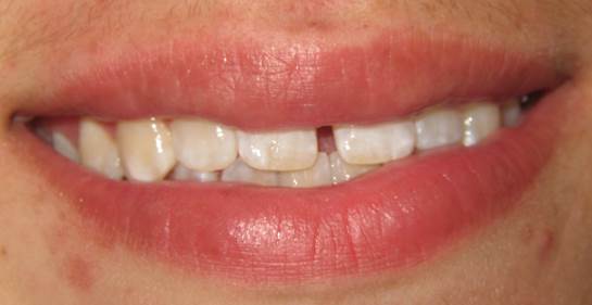 case-13-before-invisalign