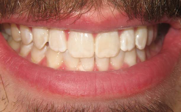 case-14-2-after-invisalign-and-zoom