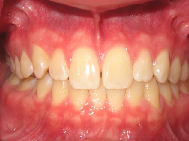 case-14-before-invisalign