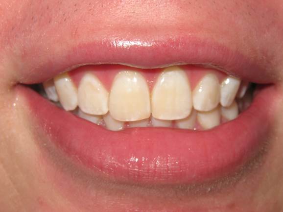 case-15-after-invisalign-and-zoom