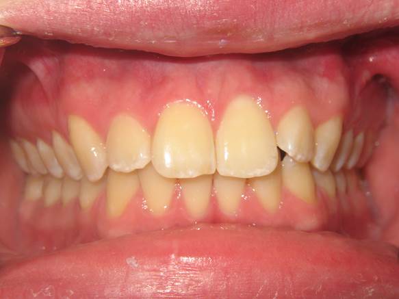 case-15-before-invisalign-and-zoom