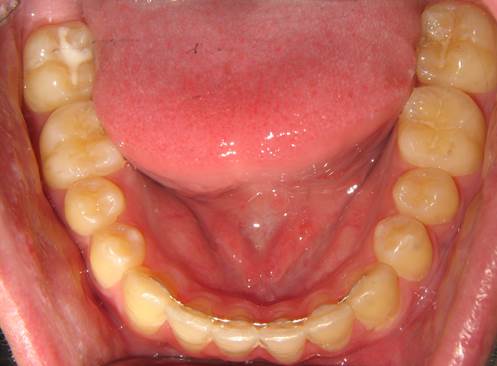 case-17-after-ortho-and-lower-crowding-and-bonded-retainer