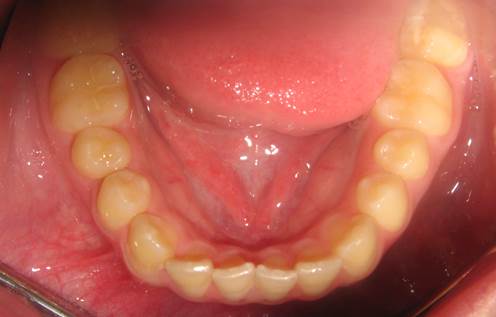 case-17-before-ortho-and-lower-crowding-and-bonded-retainer