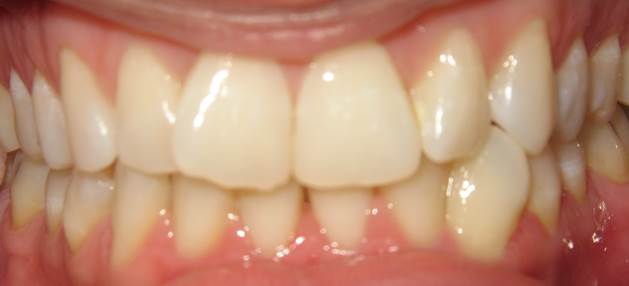 case-18-before-ortho-and-straight-wire