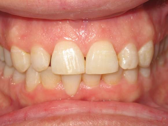 case-19-after-invisalign-and-zoom-patient-didnt-want-to-close-gap