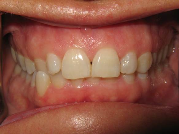 case-19-before-invisalign-and-zoom-patient-didnt-want-to-close-gap