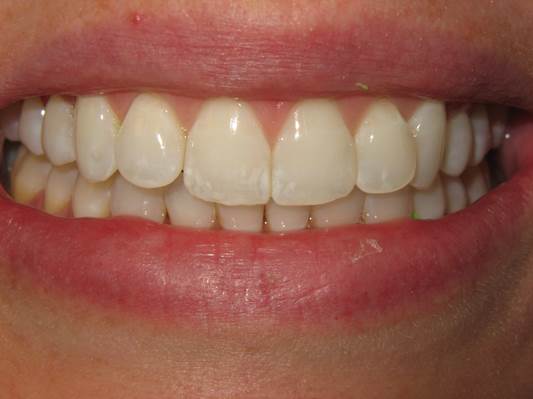 case-20-before-invisalign-express