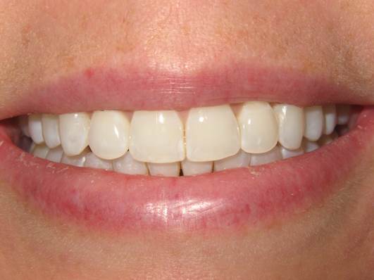 case-20-after-invisalign-express