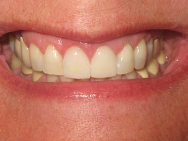 case-4-after-zoom-crown-lengthening-and-crowns