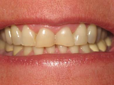 case-4-before-zoom-crown-lengthening-and-crowns