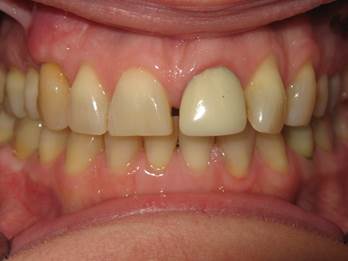 case-5-before-ortho-zoom-and-new-crown