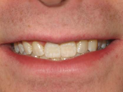 case-6-after-crown-lengthening-zoom-and-single-crown