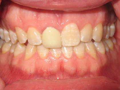 case-6-before-crown-lengthening-zoom-and-single-crown