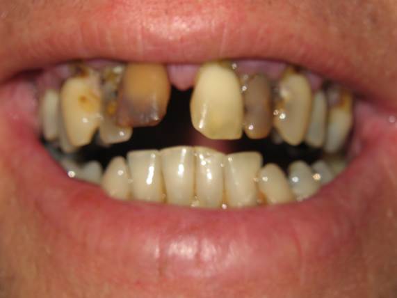 case-9-before-dentures