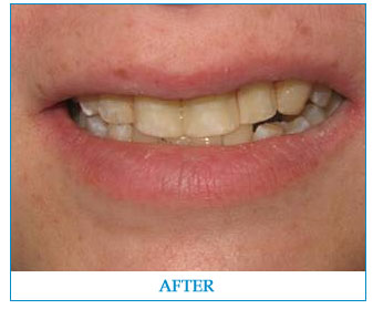 cosmetic-bondingcomposites-after