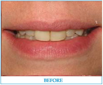 porcelain-veneers-1-before