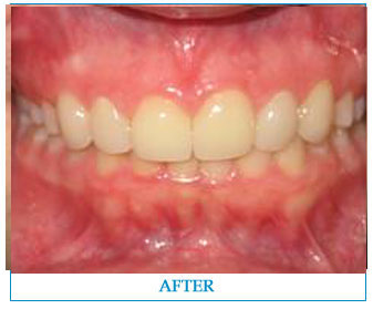 porcelain-veneers-2-after