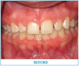 porcelain-veneers-2-before