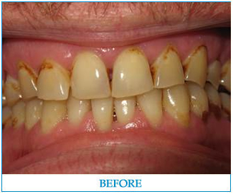 porcelain-veneers-1-before