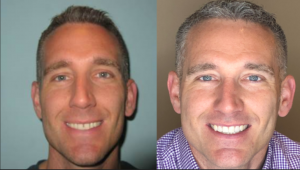 Teeth Veneers Before and After - Endres Gateway Dentistry Montgomery OH