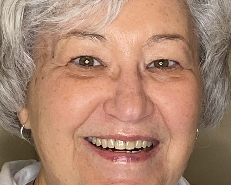 An Endres Gateway Dentistry patient after their Invisalign treatment.