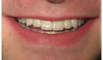 Restorative porcelain bridges in Loveland.