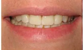 After photo of a porcelain veneers patient at Endres Gateway Dentistry.