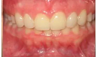 Natural looking porcelain veneer results of an Endres Dentistry patient.