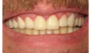 A smile makeover patient of Endres Gateway Dentistry.