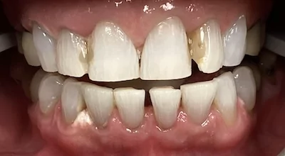Endres Gateway Dentistry patient before restorative treatment.