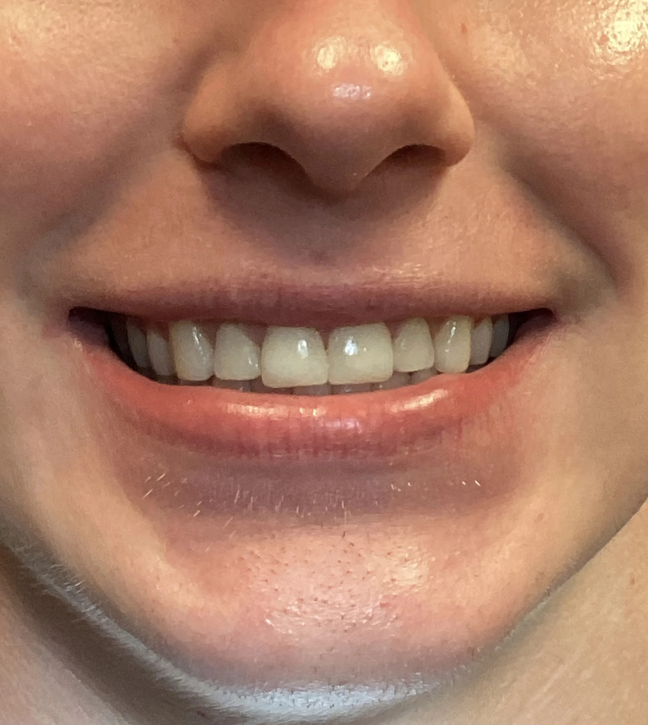 Henry - After Broken Tooth Repair