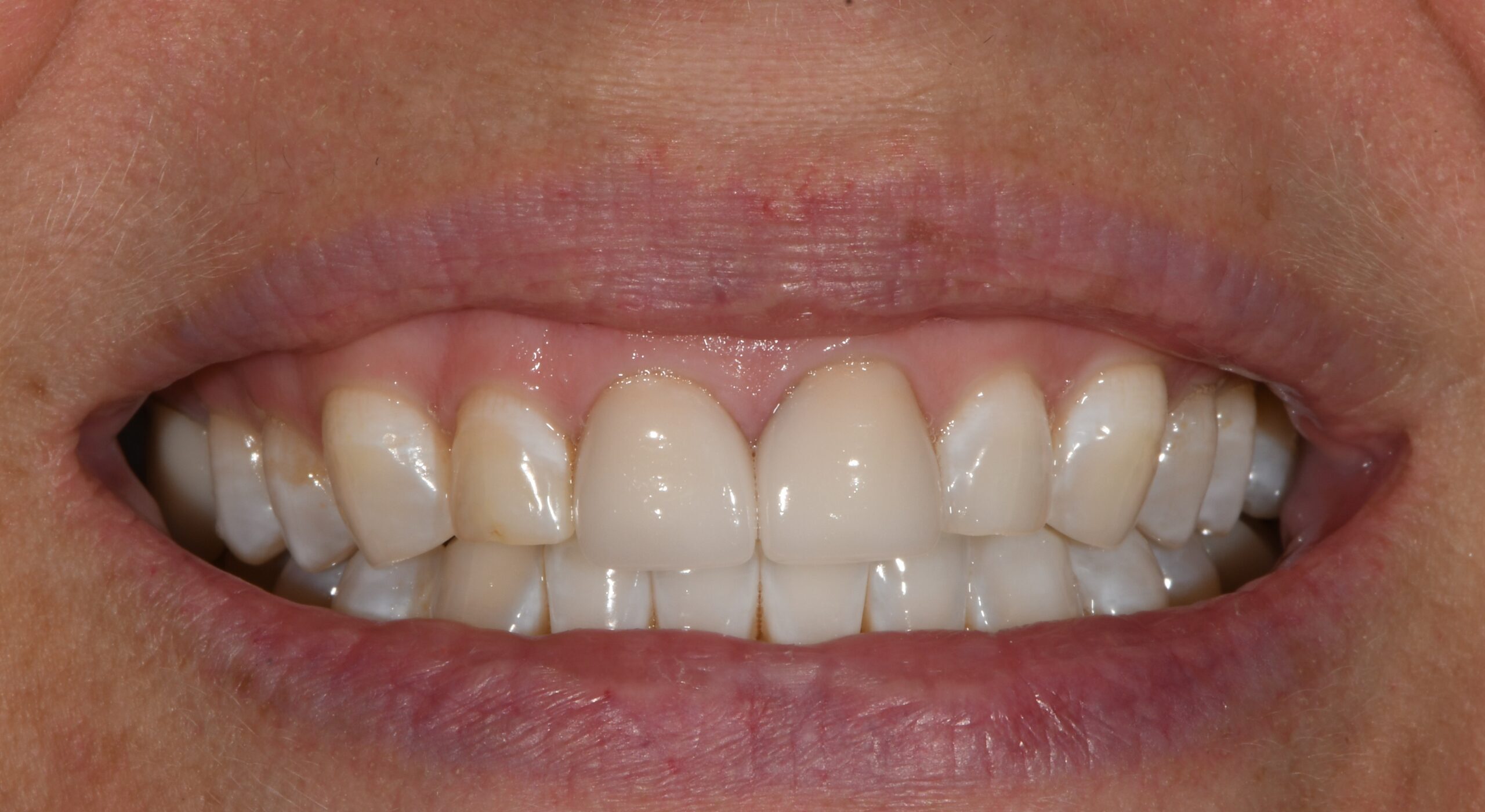 Laura Fremeau Before at Home KOR Teeth Whitening
