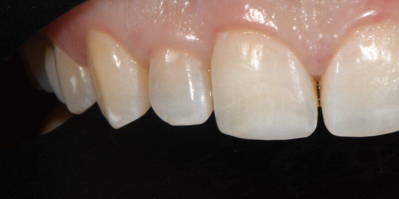 A repaired chipped tooth.