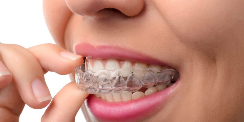 A woman putting in a clear aligner.