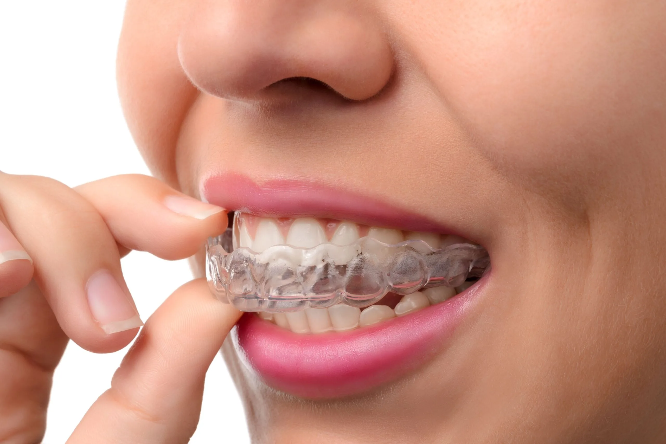 A woman putting in a clear aligner.