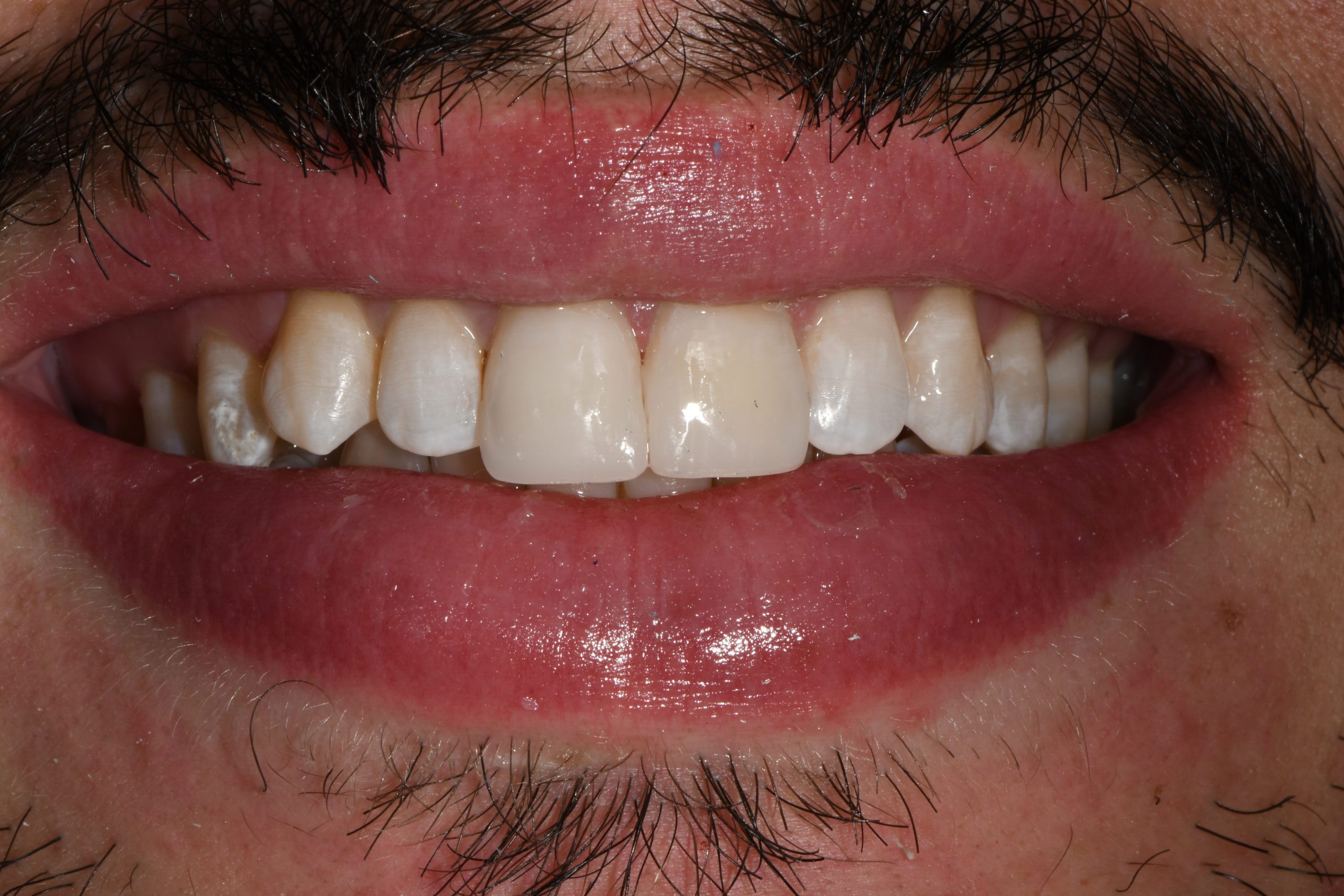 Gabriel David - After cosmetic dental treatment