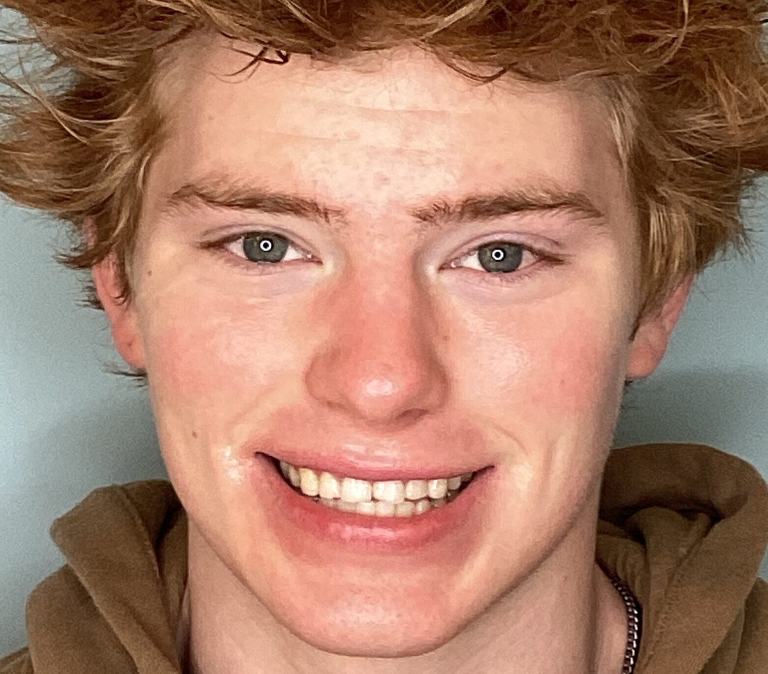 Henry - Before cosmetic bonding