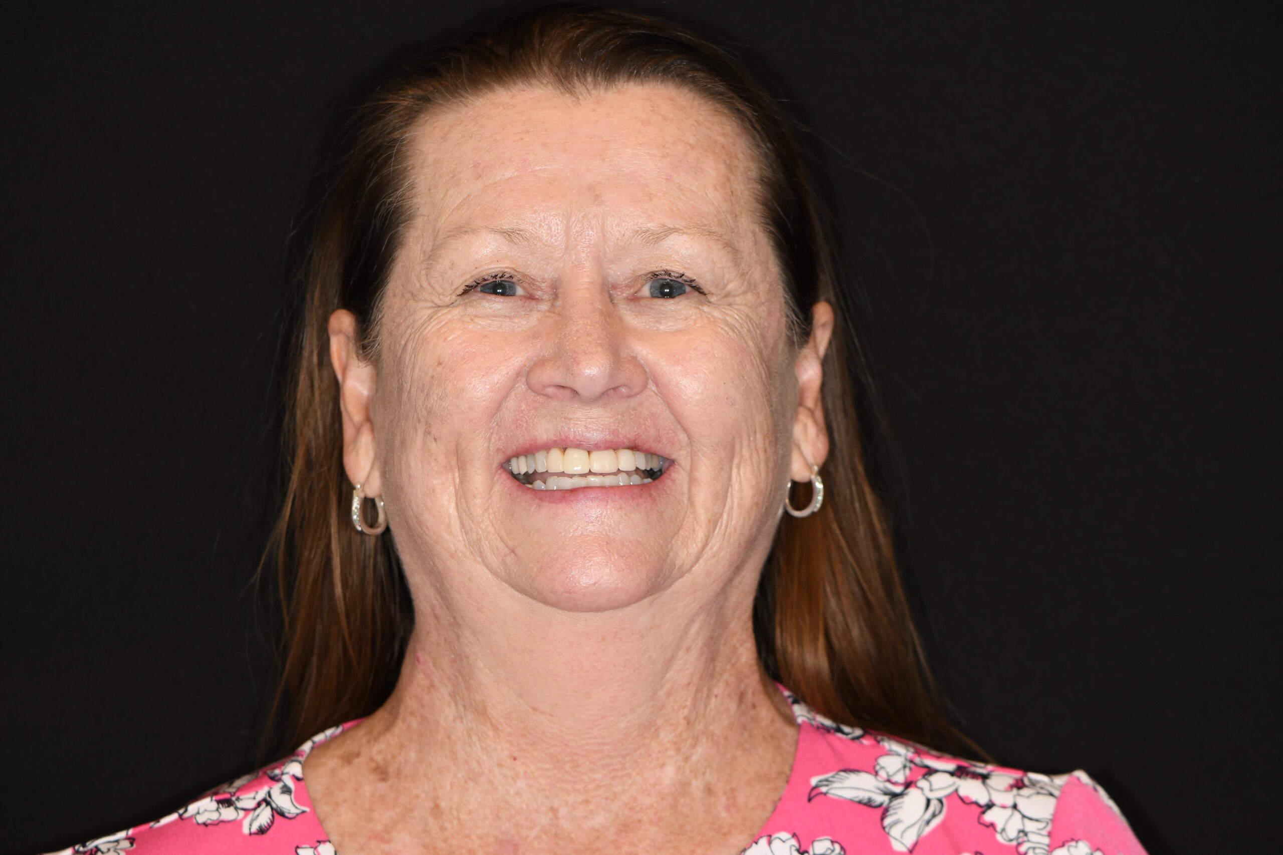 Lisa Taulbee after KOR Teeth Whitening and Dental Implant