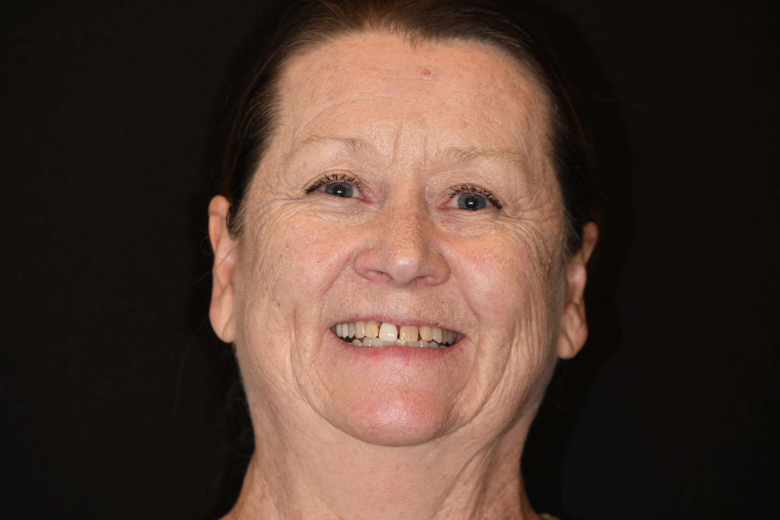Lisa Taulbee before KOR Teeth Whitening and Dental Implant
