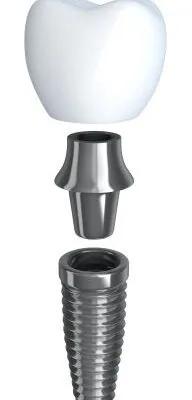 A dental implant graphic image.