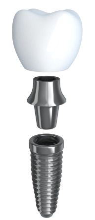 A dental implant graphic image.