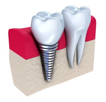 A graphic image of a dental implant in the jawbone.
