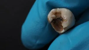 Close up of an extracted tooth