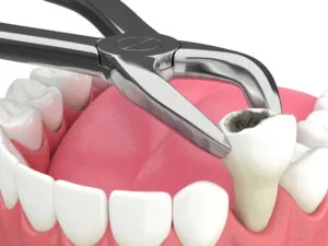 Simple tooth extraction procedure performed using forceps