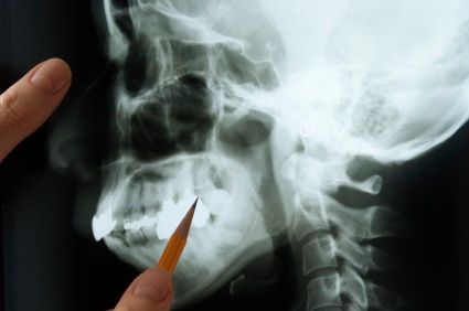 An X-ray of a jawbone.