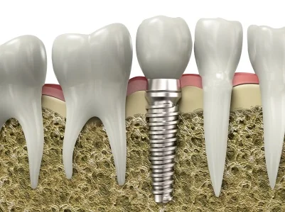 A graphic image of a dental implant installed in jawbone.